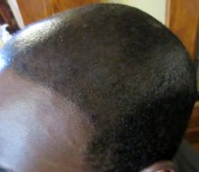 Scalp Micropigmentation