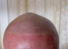 Scalp Micropigmentation Image eClassifieds4u 2