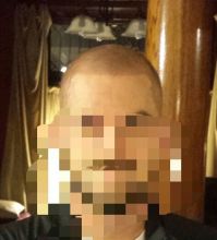 Scalp Micropigmentation Image eClassifieds4u 3