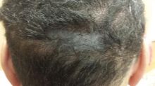 Scalp Micropigmentation Image eClassifieds4u 4
