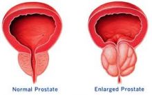 Prostate (external and internal)