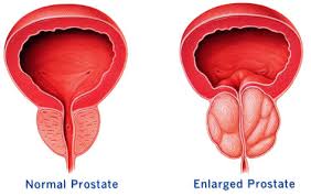 Prostate (external and internal) Image eClassifieds4u
