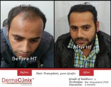 Hair Transplant In Delhi For Fast Regrow Your Hair