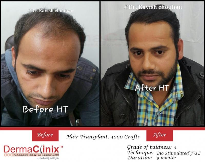 Hair Transplant In Delhi For Fast Regrow Your Hair Image eClassifieds4u