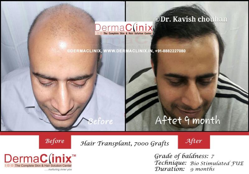 Hair Transplant In Delhi For Fast Regrow Your Hair Image eClassifieds4u