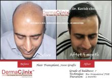 Hair Transplant In Delhi For Fast Regrow Your Hair Image eClassifieds4u 2