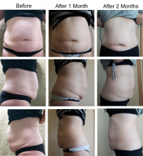 30% Off Fat-Freezing & ALL TREATMENTS!! New Location Grand Opening!! Get Your Summer Body Ready! Image eClassifieds4u 1