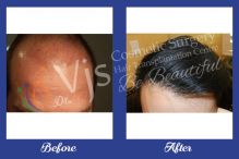 Affordable Priced Hair Transplant Surgery in Vizag